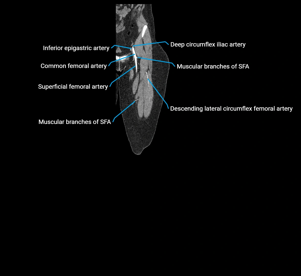 CTA lower limb coronal cross sectional anatomy labelled image _13 (1).webp